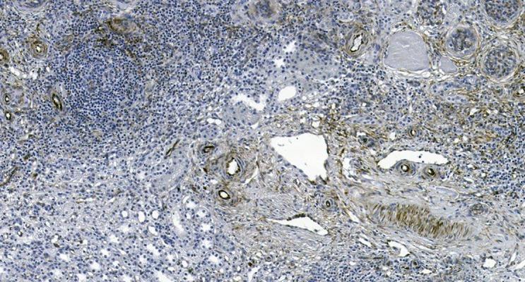 https://cdn.ncbi.nlm.nih.gov/pmc/blobs/b606/5637626/b297c50544fa/amjcaserep-18-1066-g009.jpg
