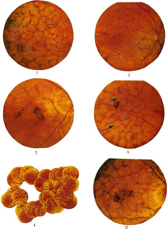 https://cdn.ncbi.nlm.nih.gov/pmc/blobs/b679/1017464/80b354caa9eb/brjopthal00241-0039-a.jpg