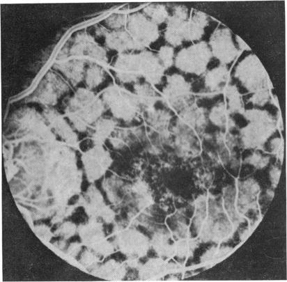 https://cdn.ncbi.nlm.nih.gov/pmc/blobs/b679/1017464/e24c91a07807/brjopthal00241-0041-a.jpg