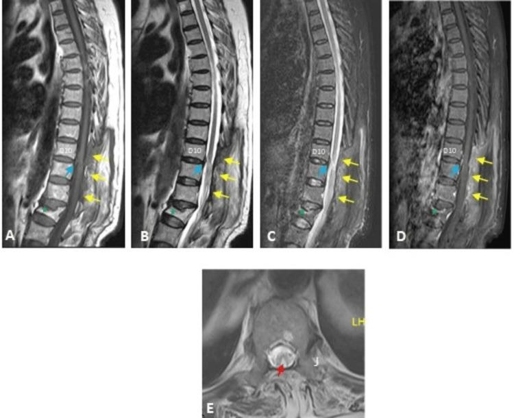 https://cdn.ncbi.nlm.nih.gov/pmc/blobs/b67a/10929682/7bde5e1f9c4a/cureus-0016-00000054009-i11.jpg
