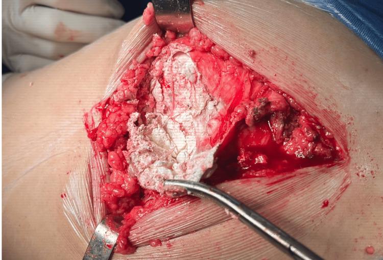 https://cdn.ncbi.nlm.nih.gov/pmc/blobs/b6f9/11224643/90dba0fb42e2/cureus-0016-00000061698-i03.jpg