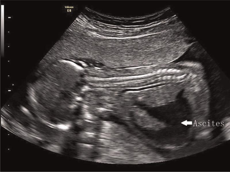 https://cdn.ncbi.nlm.nih.gov/pmc/blobs/b70d/5690727/ab057229fb47/medi-96-e8474-g004.jpg