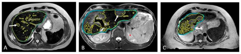 https://cdn.ncbi.nlm.nih.gov/pmc/blobs/b754/11988117/f55e4cb41b62/cancers-17-01088-g006.jpg