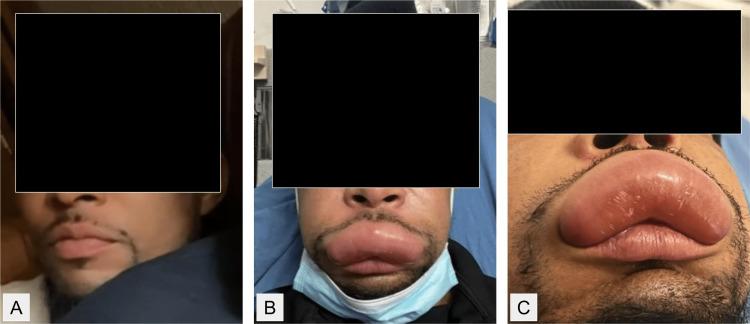 https://cdn.ncbi.nlm.nih.gov/pmc/blobs/b775/10358783/2db733959aec/cureus-0015-00000042202-i01.jpg