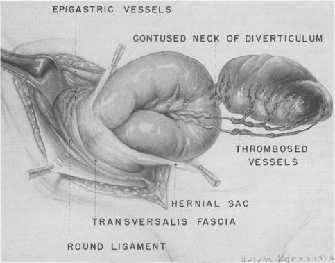https://cdn.ncbi.nlm.nih.gov/pmc/blobs/b7a4/1609421/6e0932cd5edf/annsurg01324-0120-a.jpg