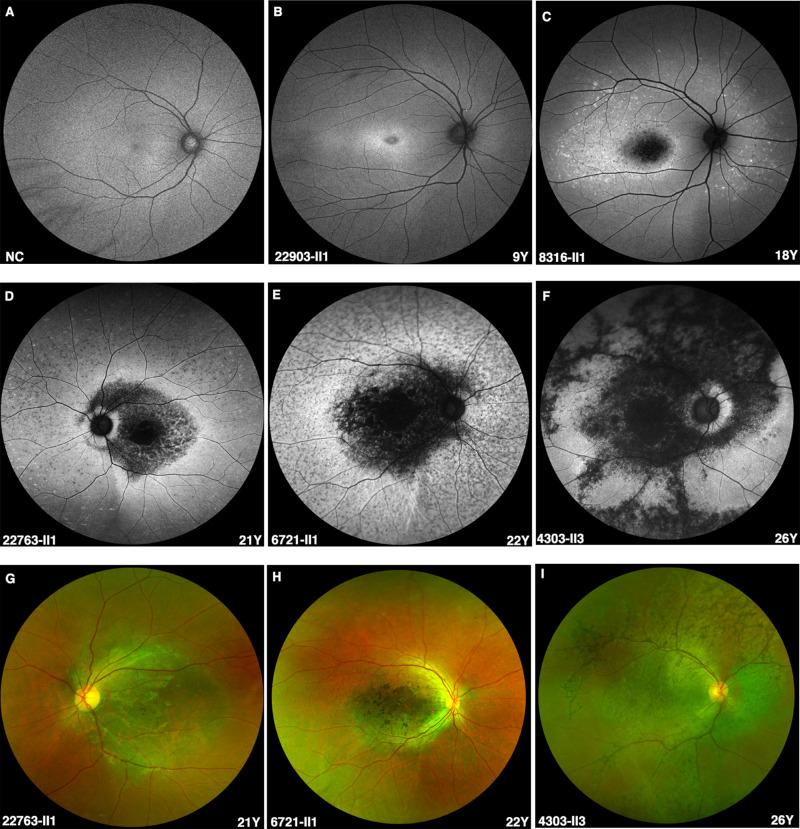 https://cdn.ncbi.nlm.nih.gov/pmc/blobs/b7aa/9150840/c12ba6428193/iovs-63-5-28-f003.jpg