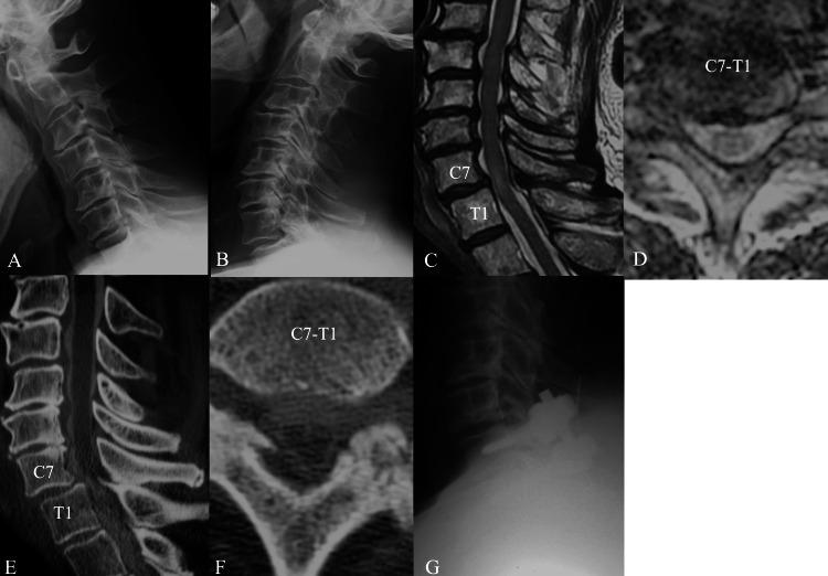 https://cdn.ncbi.nlm.nih.gov/pmc/blobs/b7c5/11176090/62555860d625/cureus-0016-00000060306-i02.jpg