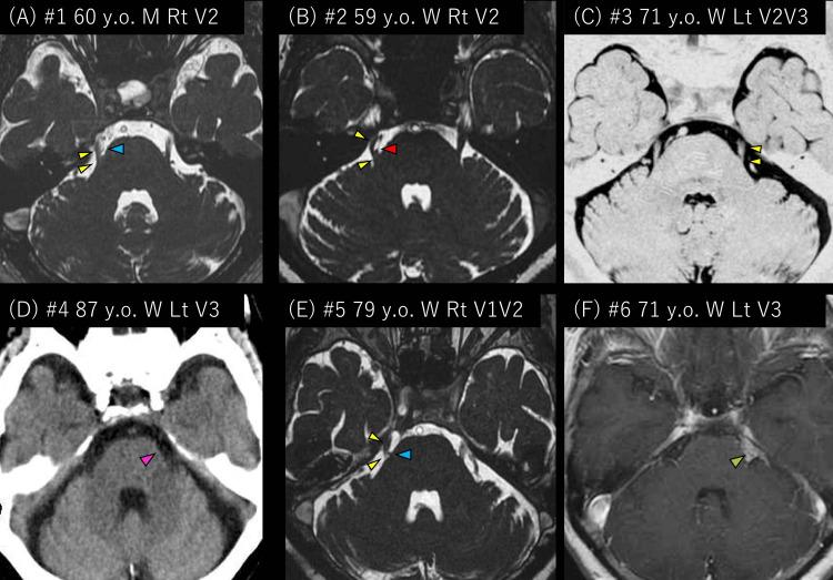 https://cdn.ncbi.nlm.nih.gov/pmc/blobs/b84a/10081972/0bbaa40f41fe/cureus-0015-00000035913-i01.jpg