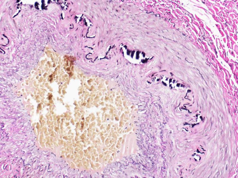https://cdn.ncbi.nlm.nih.gov/pmc/blobs/b867/7387070/e3b133deb4c7/cureus-0012-00000009210-i03.jpg