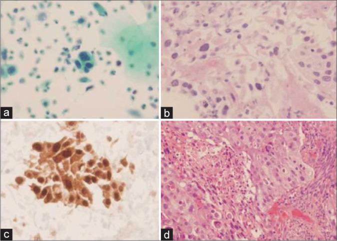 https://cdn.ncbi.nlm.nih.gov/pmc/blobs/b89e/9345115/8d7879277943/Cytojournal-19-42-g009.jpg