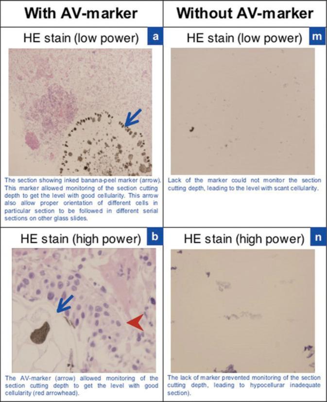 https://cdn.ncbi.nlm.nih.gov/pmc/blobs/b89e/9345115/f1e34d185911/Cytojournal-19-42-g001.jpg