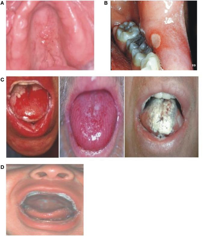 https://cdn.ncbi.nlm.nih.gov/pmc/blobs/b90e/5439125/711a222525e1/fonc-07-00089-g005.jpg