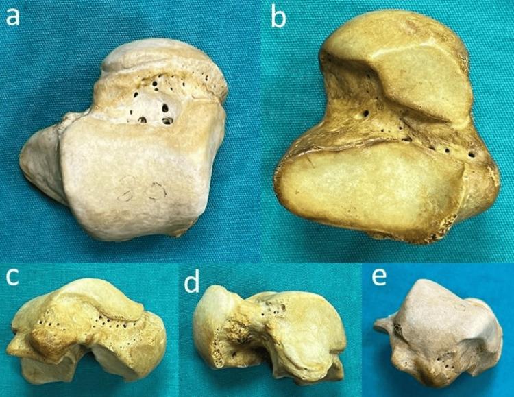 https://cdn.ncbi.nlm.nih.gov/pmc/blobs/b91b/11128186/35327bcadaa7/cureus-0016-00000059060-i03.jpg