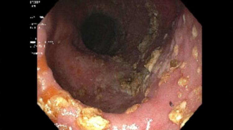 https://cdn.ncbi.nlm.nih.gov/pmc/blobs/b929/9001862/83ec698f06c5/cureus-0014-00000023061-i03.jpg