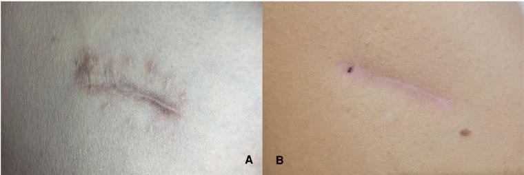 https://cdn.ncbi.nlm.nih.gov/pmc/blobs/b934/9280028/1ea2e4a44a28/fsurg-09-874983-g003.jpg