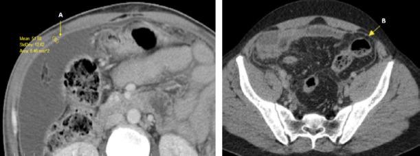 https://cdn.ncbi.nlm.nih.gov/pmc/blobs/b952/10443133/ac58ad191b87/TJTES-28-428-g003.jpg