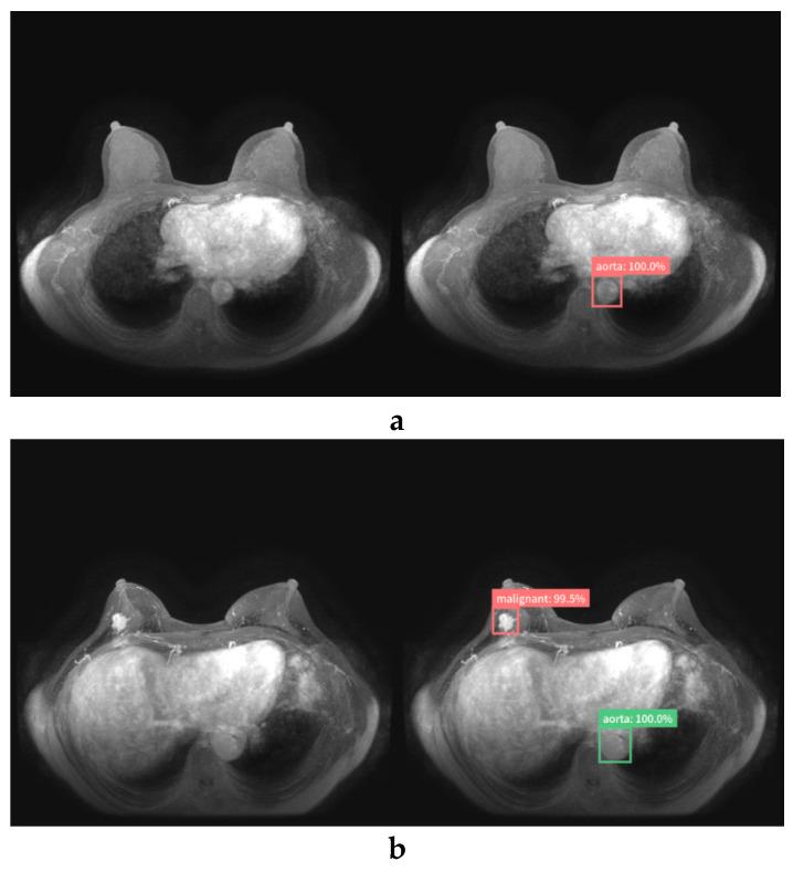 https://cdn.ncbi.nlm.nih.gov/pmc/blobs/b972/7277981/b3ea4dce2cc3/diagnostics-10-00330-g005a.jpg