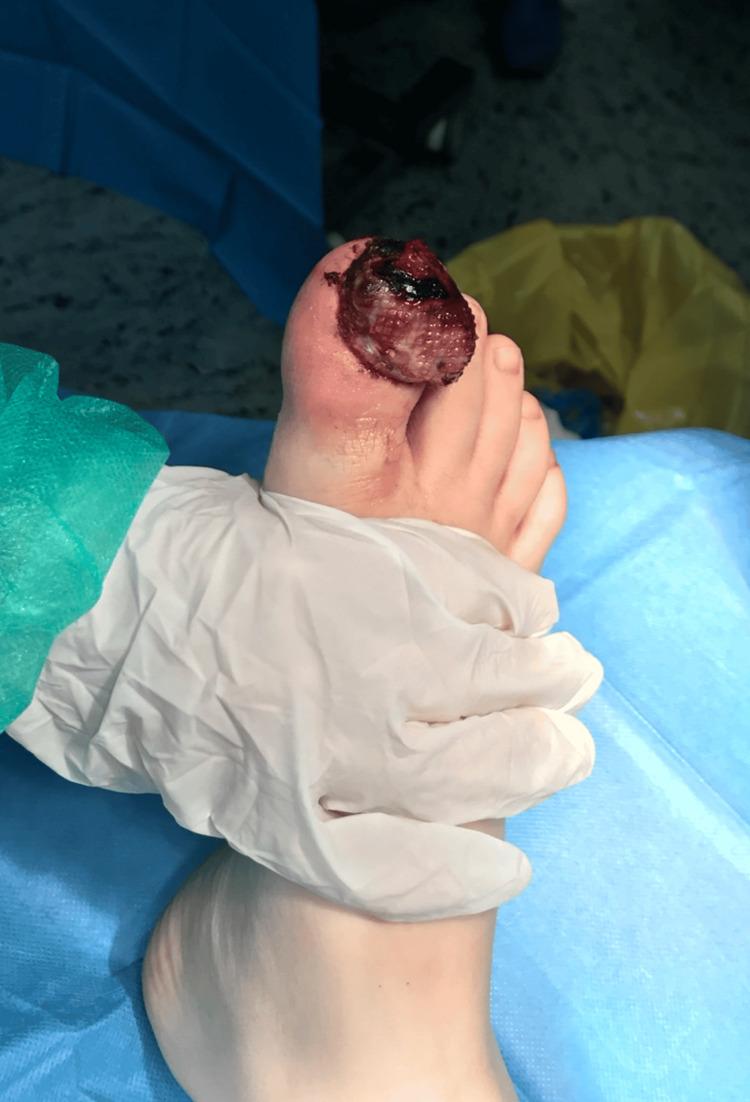 https://cdn.ncbi.nlm.nih.gov/pmc/blobs/b999/12338003/e8d0a1d1749f/cureus-0017-00000087778-i02.jpg