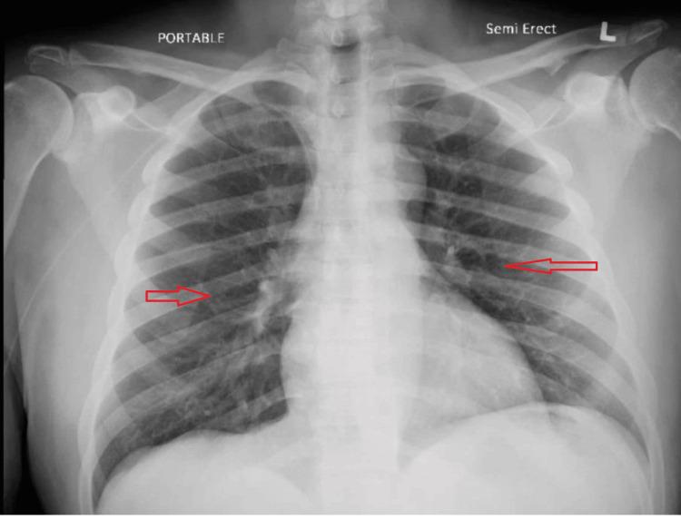 https://cdn.ncbi.nlm.nih.gov/pmc/blobs/b9be/12121850/0c39b384f815/cureus-0017-00000083195-i03.jpg