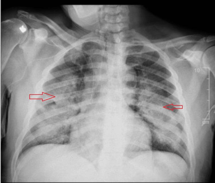 https://cdn.ncbi.nlm.nih.gov/pmc/blobs/b9be/12121850/85497e8d3f30/cureus-0017-00000083195-i01.jpg