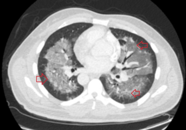 https://cdn.ncbi.nlm.nih.gov/pmc/blobs/b9be/12121850/d6dbf44c560c/cureus-0017-00000083195-i02.jpg