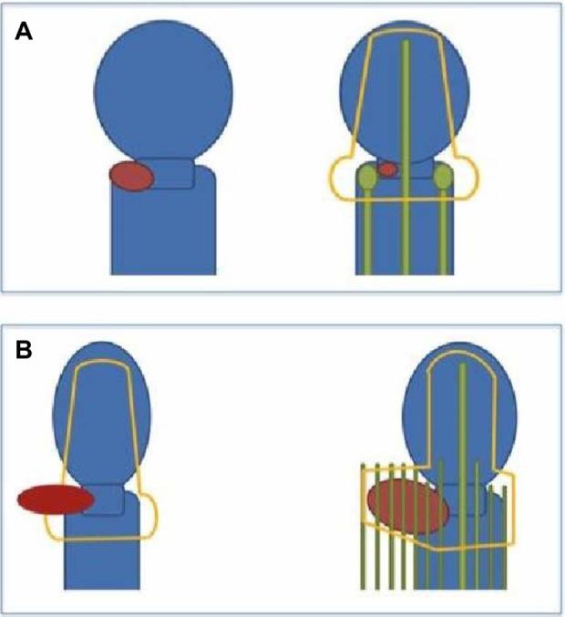 https://cdn.ncbi.nlm.nih.gov/pmc/blobs/b9cb/4045176/6585bc8f5884/ijwh-6-555Fig1.jpg
