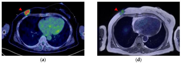 https://cdn.ncbi.nlm.nih.gov/pmc/blobs/b9d9/10252794/6c374c3475ba/diagnostics-13-01851-g005a.jpg