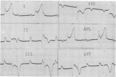 https://cdn.ncbi.nlm.nih.gov/pmc/blobs/b9dc/458564/6e1ee5196a92/brheartj00275-0054-a.jpg