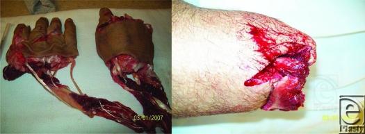 https://cdn.ncbi.nlm.nih.gov/pmc/blobs/ba4c/3228577/6592dbb3fa33/eplasty11e48_fig2.jpg