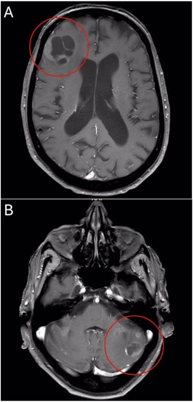 https://cdn.ncbi.nlm.nih.gov/pmc/blobs/baa5/12021617/6e42d23cb0be/fonc-15-1555897-g001.jpg