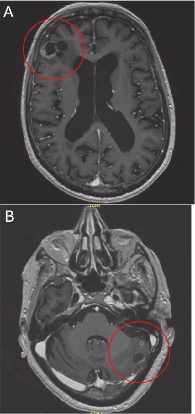 https://cdn.ncbi.nlm.nih.gov/pmc/blobs/baa5/12021617/d79168ad8d4f/fonc-15-1555897-g003.jpg