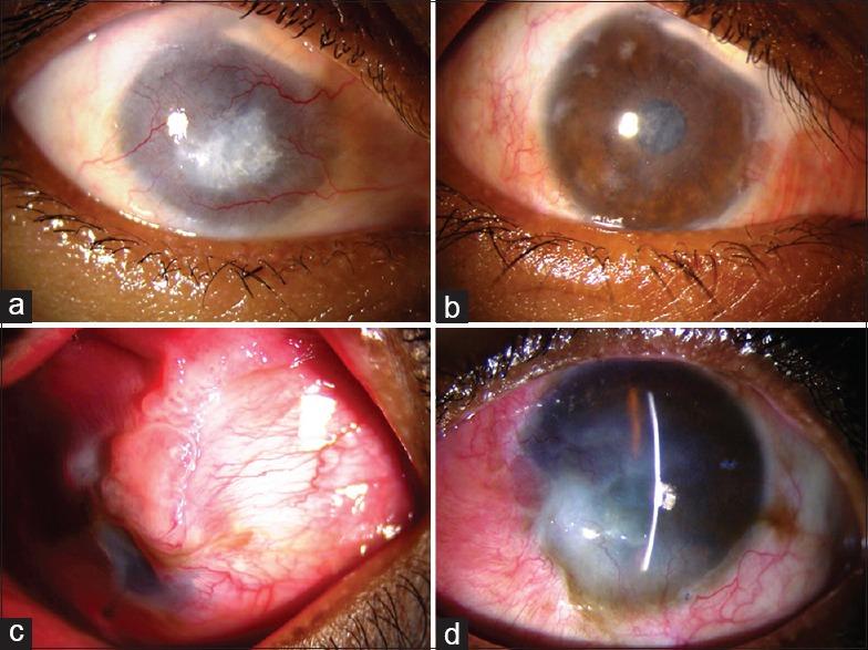 https://cdn.ncbi.nlm.nih.gov/pmc/blobs/bad7/5369291/9cf8cbfb7c42/IJO-65-35-g005.jpg