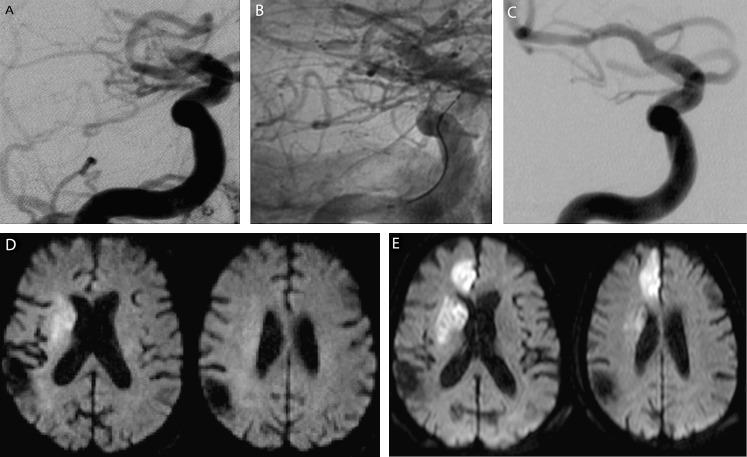 https://cdn.ncbi.nlm.nih.gov/pmc/blobs/bb22/3240775/21496c9d8f3e/neurintsurg4051fig3.jpg