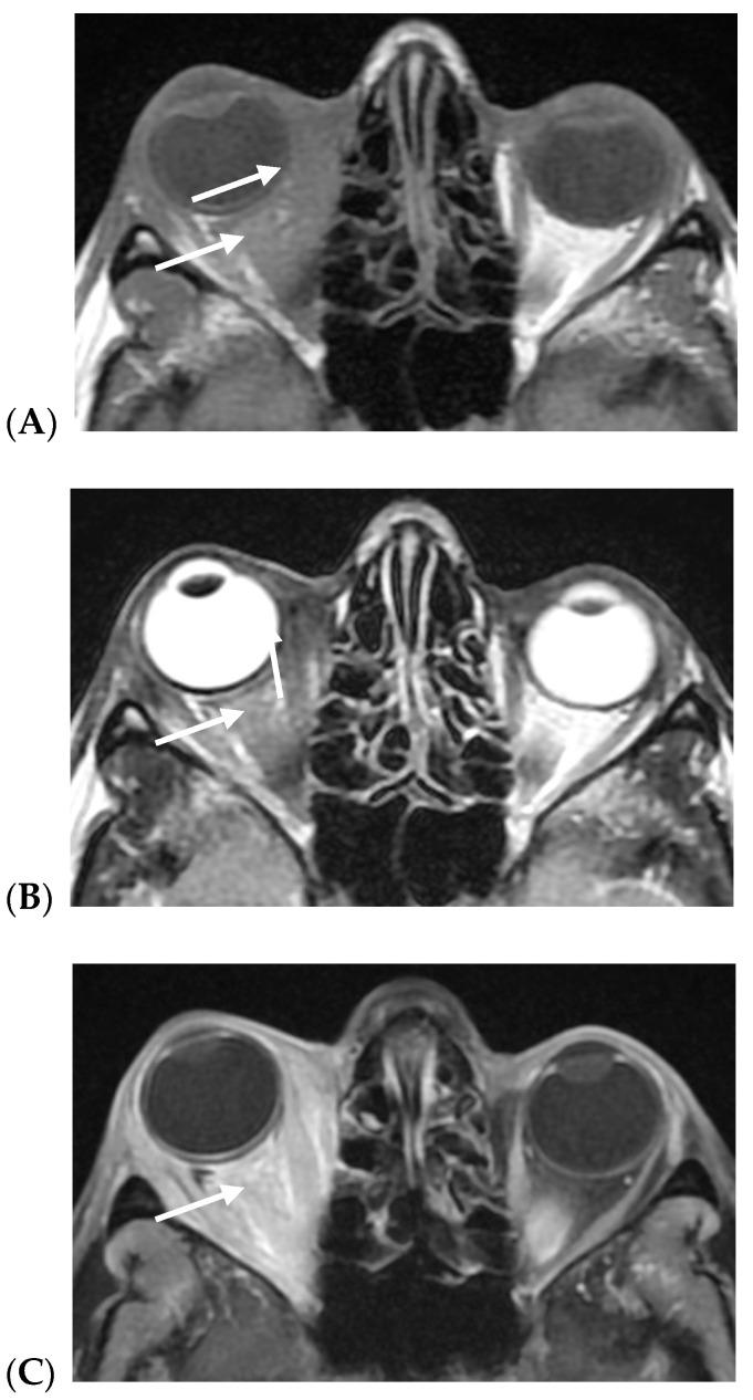 https://cdn.ncbi.nlm.nih.gov/pmc/blobs/bb2b/12153758/6dabe686c0d4/cancers-17-01875-g004.jpg