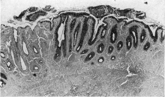 https://cdn.ncbi.nlm.nih.gov/pmc/blobs/bb5d/1411437/663edeb0a591/gut00664-0049-b.jpg