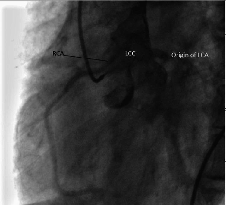 https://cdn.ncbi.nlm.nih.gov/pmc/blobs/bb74/10247158/b544df309593/cureus-0015-00000038732-i03.jpg