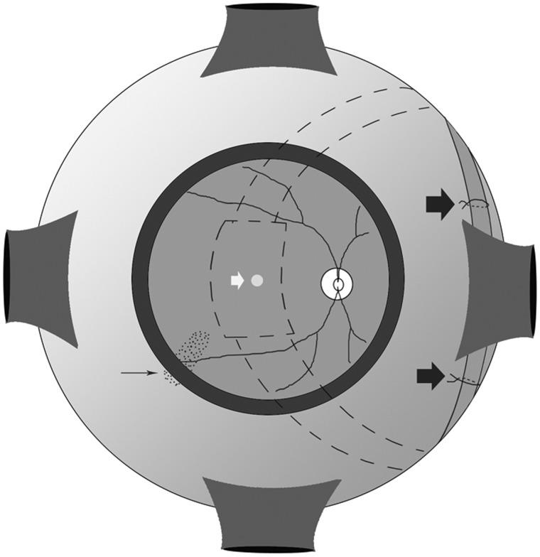 https://cdn.ncbi.nlm.nih.gov/pmc/blobs/bba6/5629954/76890a4fa69c/bjophthalmol-2016-310123f02.jpg