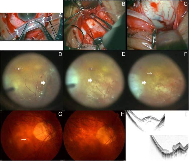 https://cdn.ncbi.nlm.nih.gov/pmc/blobs/bba6/5629954/d74711d1aaef/bjophthalmol-2016-310123f01.jpg