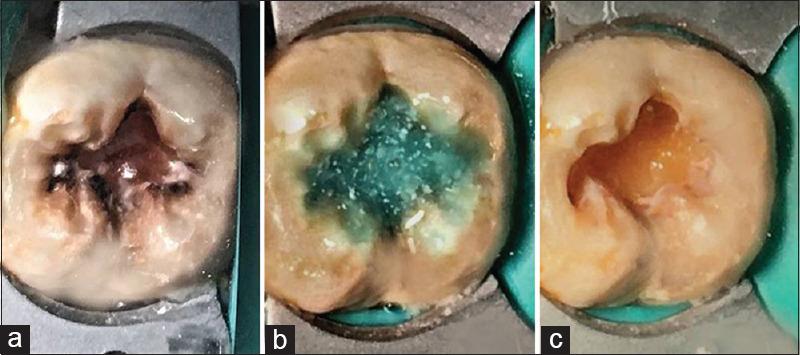 https://cdn.ncbi.nlm.nih.gov/pmc/blobs/bbac/7720760/71c74a0c16db/JCD-23-163-g002.jpg