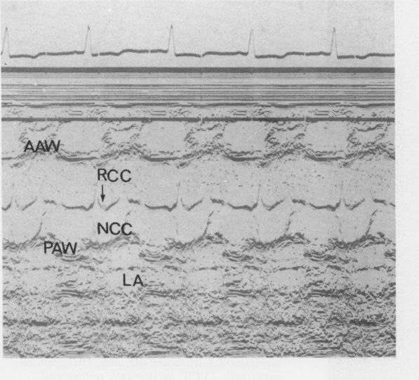 https://cdn.ncbi.nlm.nih.gov/pmc/blobs/bc04/482671/28b7b7787968/brheartj00188-0077-a.jpg