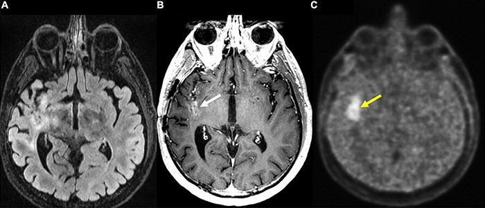 https://cdn.ncbi.nlm.nih.gov/pmc/blobs/bc64/8904563/33b449d90075/fnins-16-787755-g007.jpg