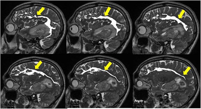 https://cdn.ncbi.nlm.nih.gov/pmc/blobs/bc64/8904563/937a47643e31/fnins-16-787755-g009.jpg