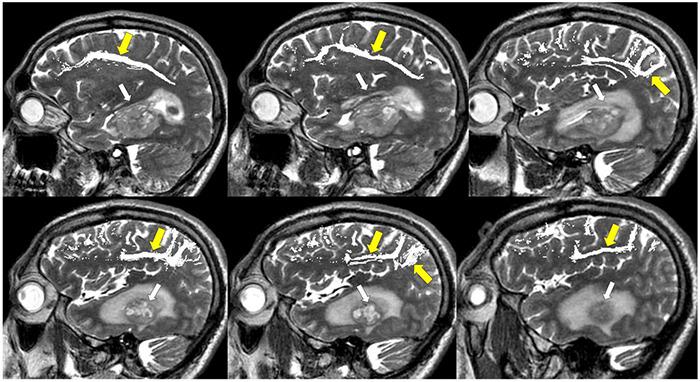 https://cdn.ncbi.nlm.nih.gov/pmc/blobs/bc64/8904563/fc214beea992/fnins-16-787755-g012.jpg