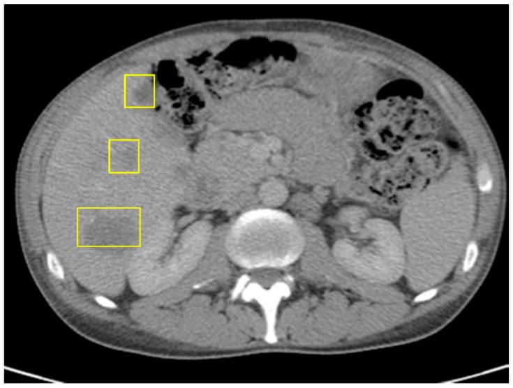 https://cdn.ncbi.nlm.nih.gov/pmc/blobs/bc65/12293316/6af90ca8ad9b/curroncol-32-00370-g004.jpg