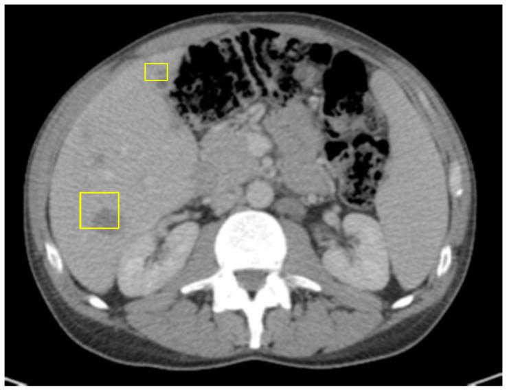 https://cdn.ncbi.nlm.nih.gov/pmc/blobs/bc65/12293316/d7d037cd8f37/curroncol-32-00370-g005.jpg