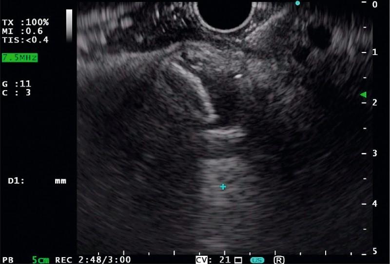 https://cdn.ncbi.nlm.nih.gov/pmc/blobs/bcb0/5361875/190e4daaacd3/10-1055-s-0042-122009-i699ei2.jpg