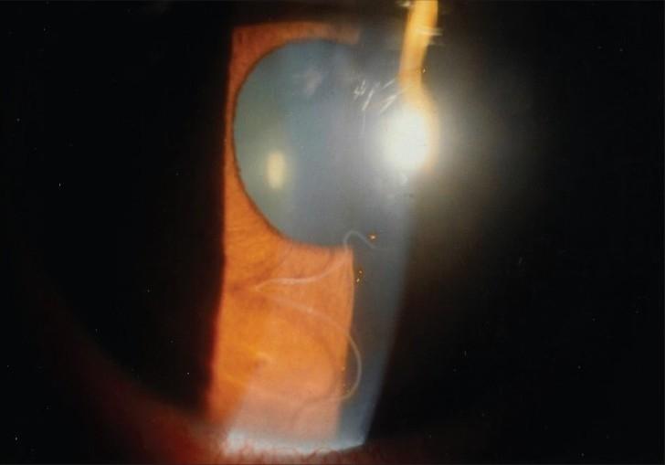 https://cdn.ncbi.nlm.nih.gov/pmc/blobs/bcde/2612991/cf4e59968453/IndianJOphthalmol-56-501-g001.jpg
