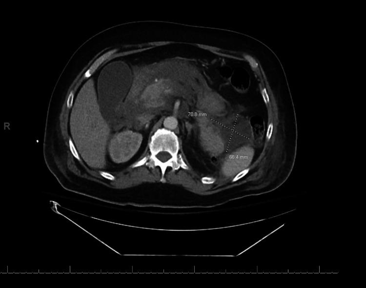 https://cdn.ncbi.nlm.nih.gov/pmc/blobs/bce7/9012552/c42851d80e31/cureus-0014-00000023267-i02.jpg