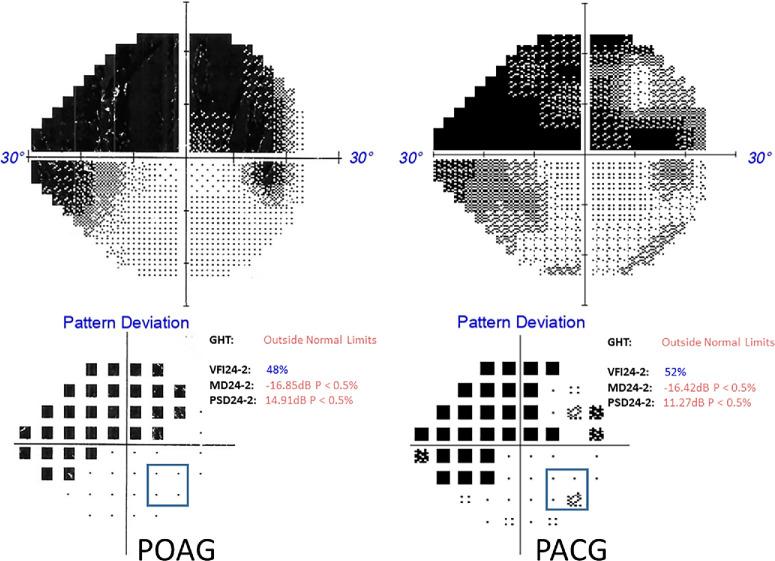 https://cdn.ncbi.nlm.nih.gov/pmc/blobs/bcf5/11114617/5778cc59d040/iovs-65-5-33-f001.jpg