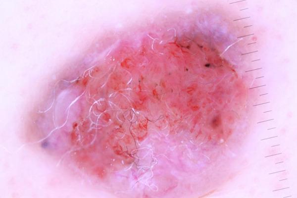 https://cdn.ncbi.nlm.nih.gov/pmc/blobs/bd60/10141339/ae32f3574dd1/amjcaserep-24-e939117-g003.jpg